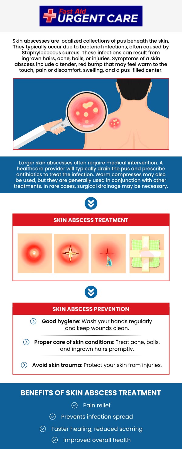 The abscess can occur when you have an open wound and bacteria enter the body. Symptoms of an abscess include swelling, tenderness, warmth to the touch, redness, or discoloration on the skin. If you, or any of your family members or friends, have an abscess, come to our clinic for treatment. For more information, contact us or join the virtual line. We have convenient locations to serve you in Bulverde Rd San Antonio TX, Bastrop TX, Alamo Ranch San Antonio TX, La Grange TX, Leon Springs San Antonio TX, New Braunfels TX, Potranco Road San Antonio TX, Dripping Springs TX, Lemon Creek Boerne TX, and Belle Chasse LA. The abscess can occur when you have an open wound and bacteria enter the body. Symptoms of an abscess include swelling, tenderness, warmth to the touch, redness, or discoloration on the skin. If you, or any of your family members or friends, have an abscess, come to our clinic for treatment. For more information, contact us or join the virtual line. We have convenient locations to serve you in Bulverde Rd San Antonio TX, Bastrop TX, Alamo Ranch San Antonio TX, La Grange TX, Leon Springs San Antonio TX, New Braunfels TX, Potranco Road San Antonio TX, Dripping Springs TX, Lemon Creek Boerne TX, and Belle Chasse LA.